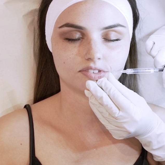 Condula Injection Lips cannula injection | SoftFil Academy